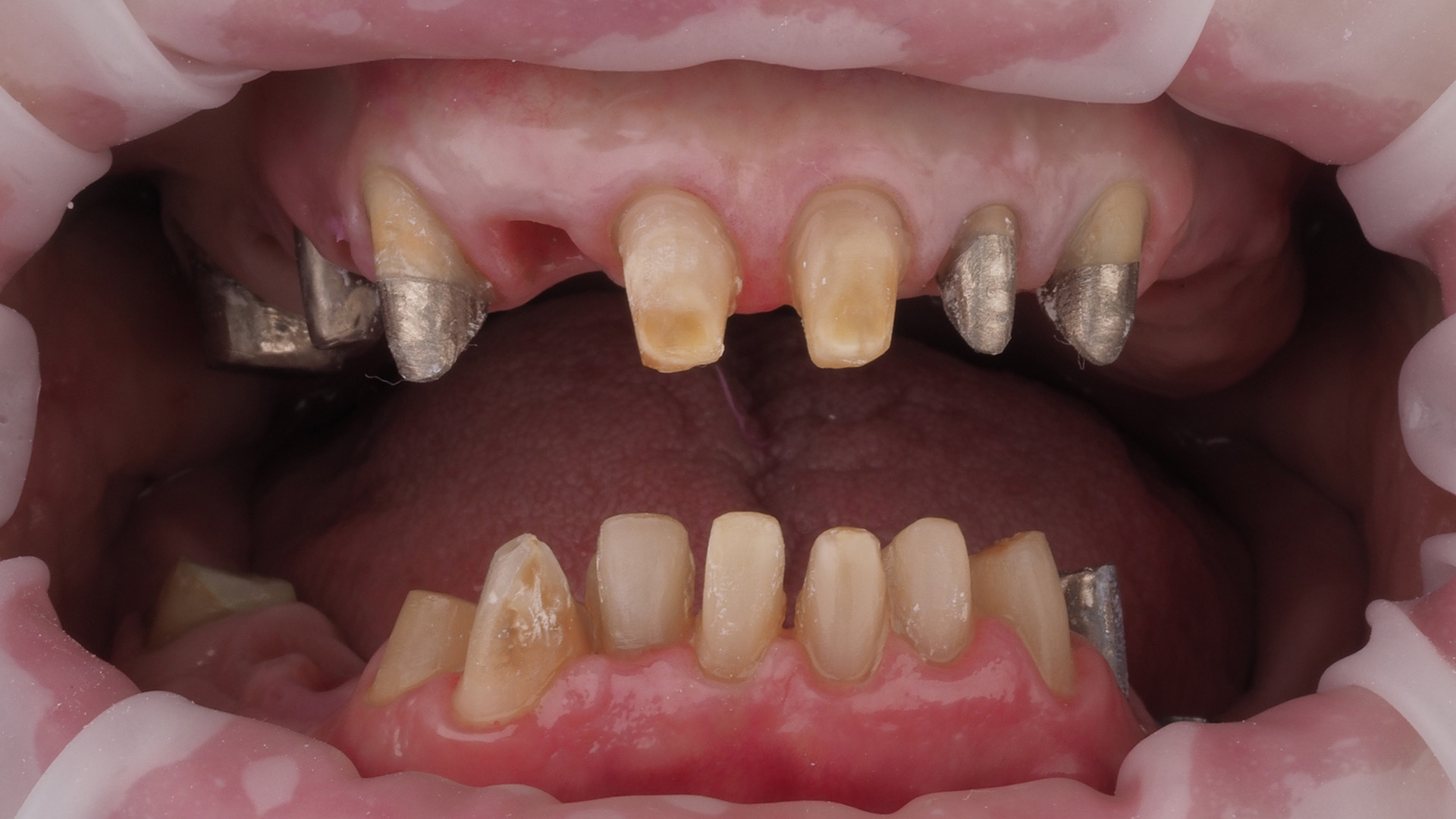 Зубы перед снятием оттисков
